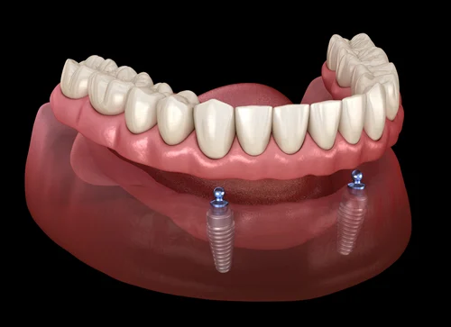 All-on-2 retained removable dentures.webp